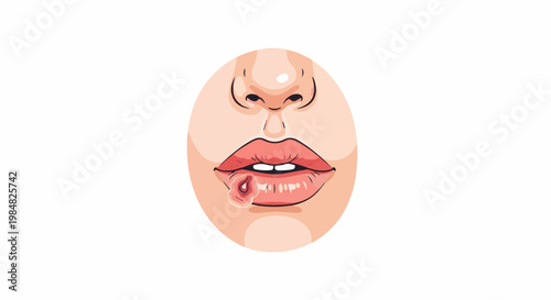 Close-up illustration of a mouth with inflamed lips and a sore