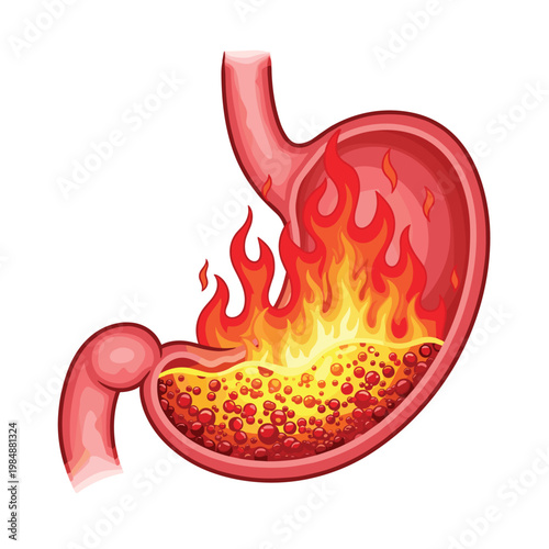 Stomach with Fire and Flames, Illustration of Acid Reflux, Heartburn, and Digestive Issues