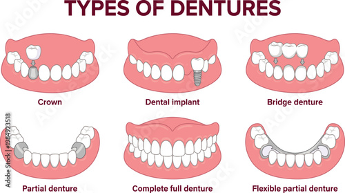 Medical Infographic Showing Different Types of Dentures and Dental Implants, Flat Vector Illustration Isolated on White
