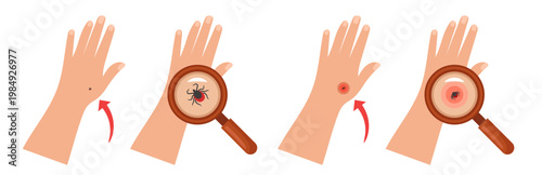 Tick ​​on a human hand. Tick bite. Tick under magnification. Hand-drawn vector illustration.
