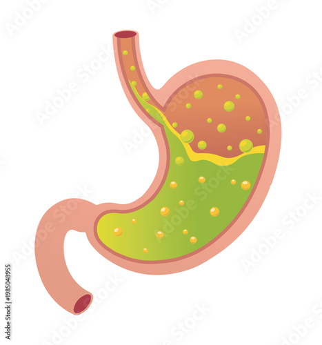 Gastroesophageal or gerd Reflux Disease. Stomach acid flowing up into the esophagus due to an open sphincter