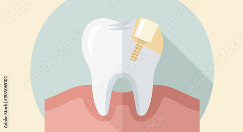 Flat design, vector graphic of a white molar tooth with a golden crown cemented on its surface, showing decay repair.