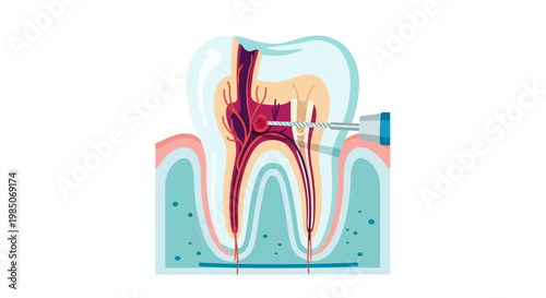 Detailed cross-section of a human molar tooth undergoing root canal treatment, with a dental instrument cleaning nerve pulp, representing dental care and endodontic procedures