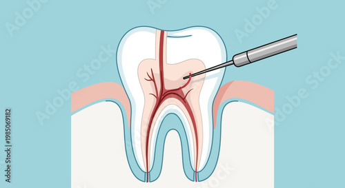 Close-up, cross-section of a human molar undergoing endodontic treatment, dental drill cleaning infected root canal, medical procedure depiction, bright flat design style, anatomical detail.