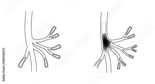 Human vascular system anatomy illustration showing healthy and obstructed blood vessels for medical education and healthcare design