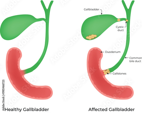 Healthy and Affected Gallbladder, Gallstone Diagram Vector Illustration