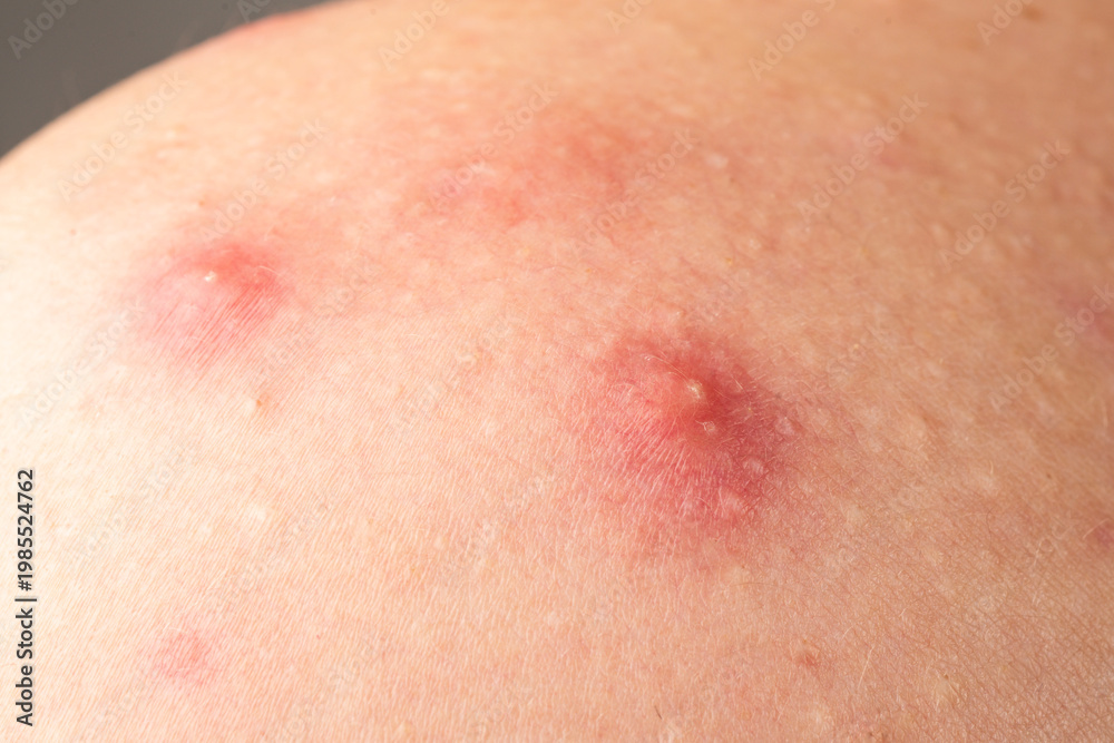 Fototapeta premium Macro shot of skin irritation with acne. Inflamed skin bumps acne macro. Skin problem background with infected bumps and acne. Detailed skin with acne.