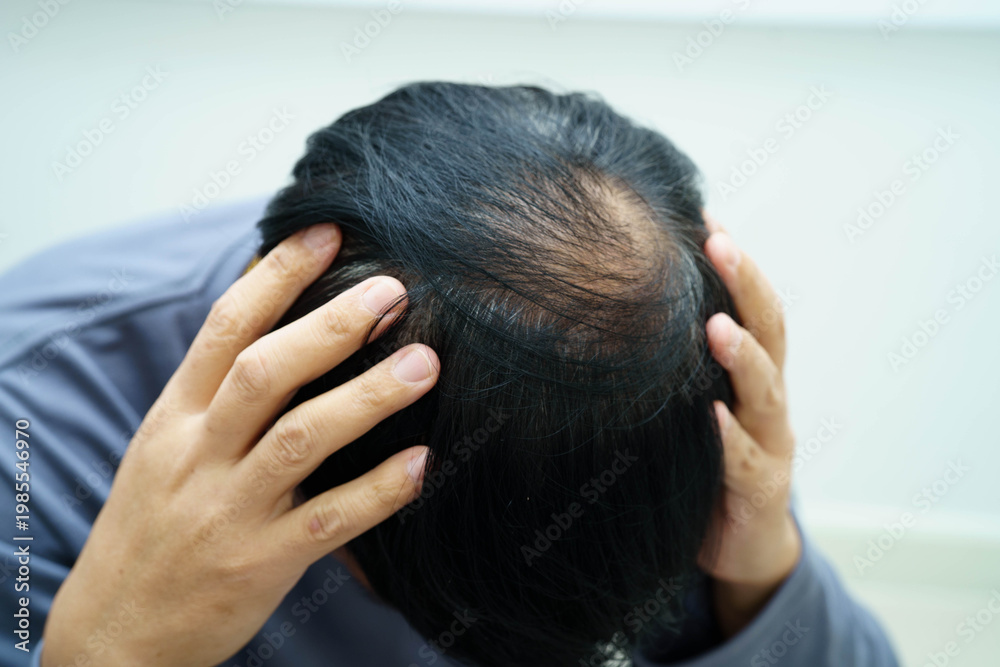 Fototapeta premium Bald head in man, hair loss treatment health problem.