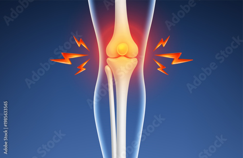 Knee joint pain inflammation concept. Human leg bones with arthritis or injury. Orthopedic medical vector illustration