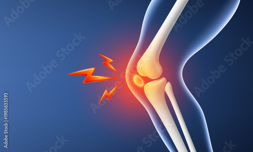 Knee joint pain inflammation concept. Human leg bones with arthritis or injury. Orthopedic medical vector illustration