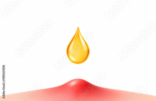 Acne pimple treatment with cosmetic serum drop. Inflamed skin blemish care concept. Dermatology skincare. Realistic vector illustration