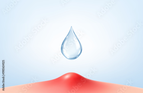 Acne pimple treatment with cosmetic serum drop. Inflamed skin blemish care concept. Dermatology skincare. Realistic vector illustration