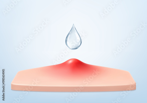 Acne pimple treatment with cosmetic serum drop. Inflamed skin blemish care concept. Dermatology skincare. Realistic vector illustration