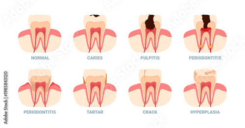 Medical diagram showing normal tooth, caries, pulpitis, periodontitis, tartar, crack, and hyperplasia for dental health education vector illustration
