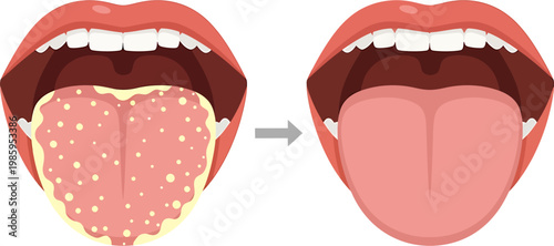 Illustration showing the difference between a healthy tongue and a tongue with thrush, highlighting treatment effectiveness