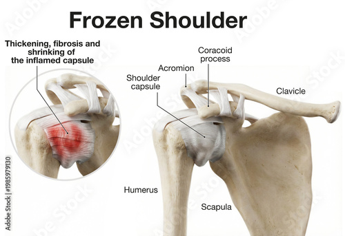 Frozen Shoulder. Medical Illustration Showing Inflammation and Fibrosis of the Shoulder Capsule. Labeled