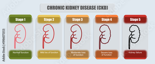 Illustration of chronic kidney disease. Stages of kidney failure in the human body. glass effect design, vector illustrations for medical, education, posters, or health elements.