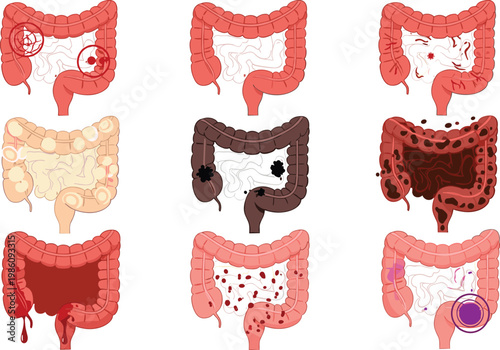 Human Intestine Disease Illustration Set Showing Digestive System Disorders Including Infection Inflammation Bleeding and Colon Problems for Medical Healthcare Education Design