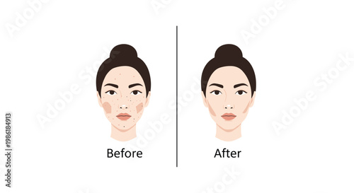 Two distinct female portraits labeled before and after demonstrate a dramatic transformation from severe facial acne to perfectly clear and radiant smooth skin.