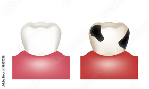 A healthy tooth and a tooth affected by decay. Vector 3D illustration.