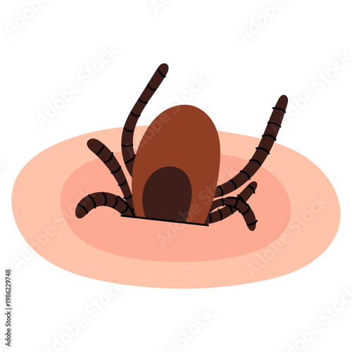 Tick Bite Close Up on Skin. Flat vector illustration of parasite attached to human skin, Lyme disease infection. Concept for medical and healthcare design.