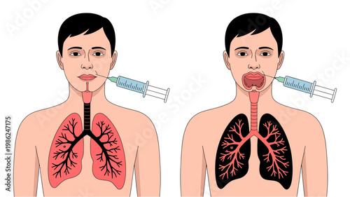 A medical illustration depicting male figures with visible lungs and throat, one receiving treatment and the other showing disease.
