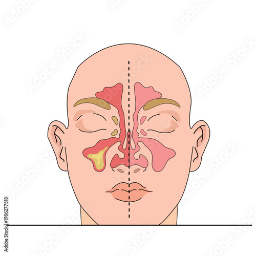 Human sinus anatomy vector with infection, congestion, and mucus visualization