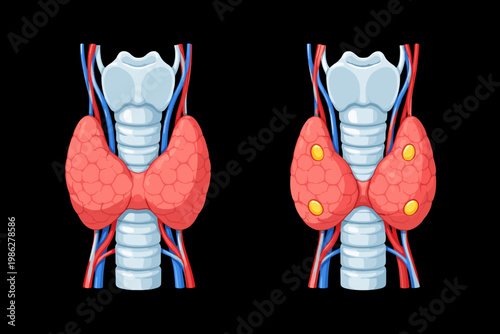 Anatomical vector illustration of the human thyroid gland and trachea. Comparison of the thyroid with and without parathyroid glands. Medical diagram for endocrine system education and health.