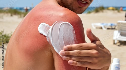 Man applying soothing cream on sunburned shoulder at beach, skin care and sun protection treatment for summer health and UV damage relief