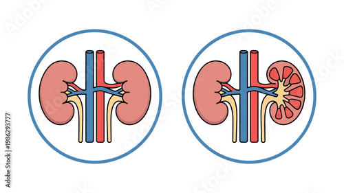 A comparison of a healthy human kidney with a diseased kidney afflicted by a visible lesion and internal damage.
