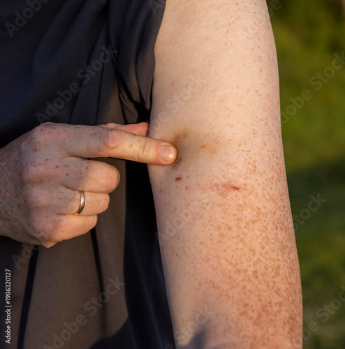 hand of a person with a large bruise , the details of the hand and the bruise on the arm where the bruise has a different color