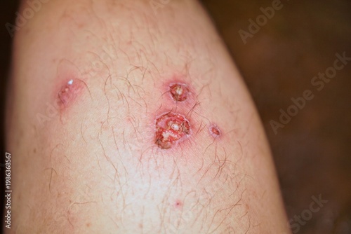 Wallpaper Mural Detailed image of a slightly purulent and itchy leprosy skin infection on a human leg with redness and skin tissue damage, a serious skin disease infection and its medical treatment. Torontodigital.ca