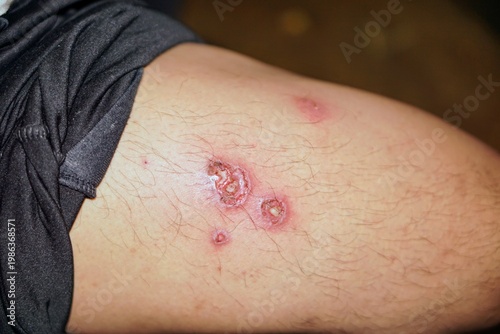 Wallpaper Mural Detailed image of a slightly purulent and itchy leprosy skin infection on a human leg with redness and skin tissue damage, a serious skin disease infection and its medical treatment. Torontodigital.ca