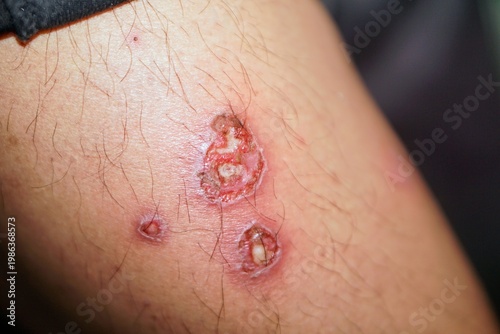 Wallpaper Mural Detailed image of a slightly purulent and itchy leprosy skin infection on a human leg with redness and skin tissue damage, a serious skin disease infection and its medical treatment. Torontodigital.ca