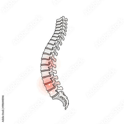 Medical vector illustration of the human vertebral column showing inflammation in the lumbar spine area, representing ankylosing spondylitis, chronic back pain, or spinal arthritis.