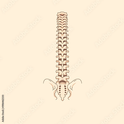 Medical Vector Illustration of Human Spine with Ankylosing Spondylitis, showing Bamboo Spine Appearance and Vertebral Fusion, Including Cervical, Thoracic, Lumbar, and Sacrum.