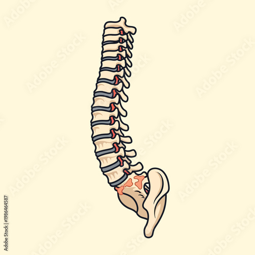 Medical illustration of a human spine depicting ankylosing spondylitis with fused vertebrae, bamboo spine syndrome, and inflammation at the sacroiliac joint and spinal discs.
