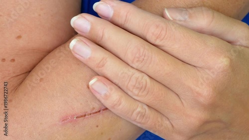 A woman treats a cut or deep scratch on her hand with home remedies