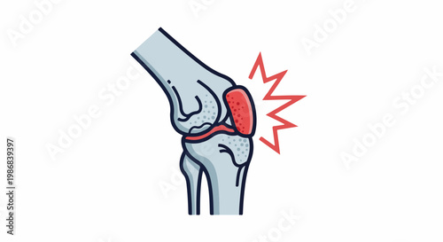 Illustration of a painful knee joint with red inflammation