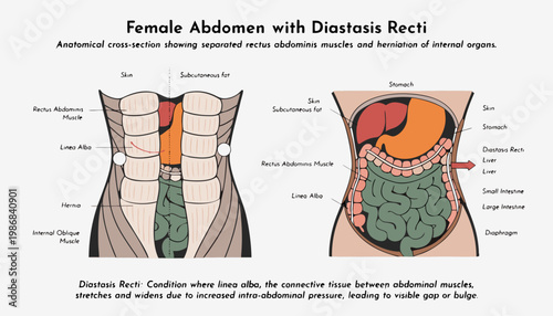 Medical illustration of female abdomen with diastasis recti anatomical cross section showing muscle separation and internal organs