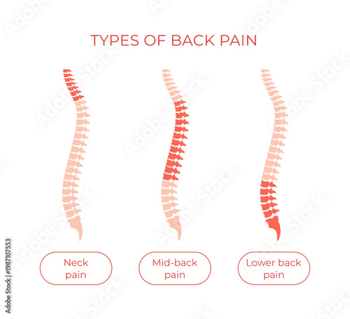 Vector types of back pain in cervical spine, thoracic spine and lumbar spine. Different kinds of backache: neck pain, mid back pain and lower back pain. Illustration of spine problems