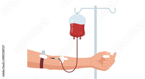 Illustration of a blood transfusion procedure with a donor arm receiving a bag of blood