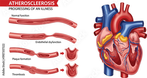 Atherosclerosis Progression Diagram Showing Normal Artery, Endothelial Dysfunction, Plaque Formation, and Thrombosis with Human Heart Vector Illustration