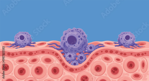 Detailed microscopic illustration of purple cancer cells invading healthy pink tissue layers against a plain blue background.