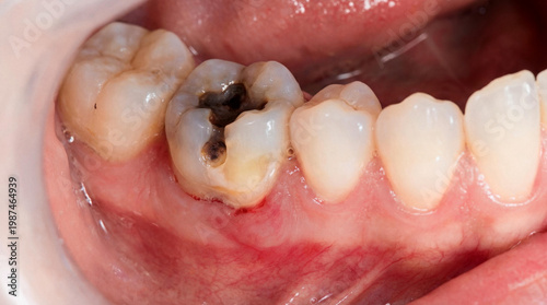 Close-up of a patient's mouth showing severe tooth decay on a molar. This dental cavity requires immediate treatment