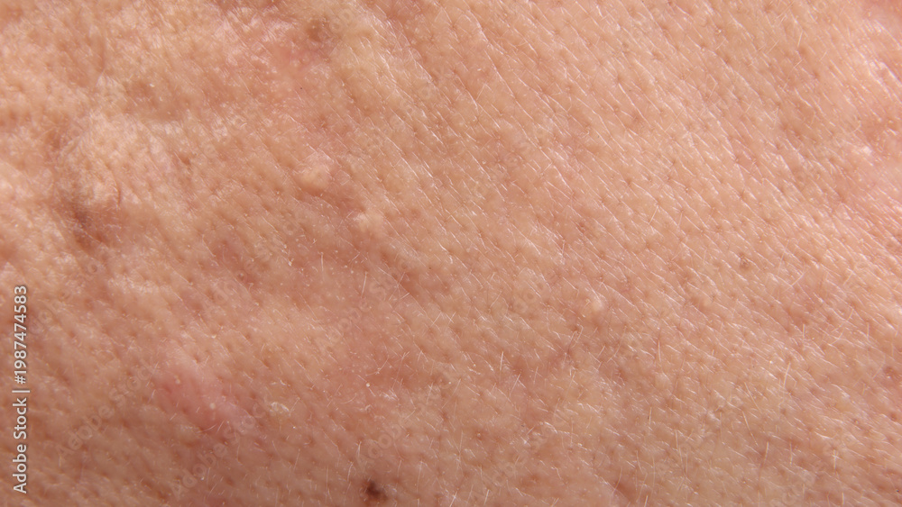 Fototapeta premium Blackheads acne. Macro close up image of facial skin and nose. showing visible pores blackheads acne marks and skin texture. Ideal for skincare dermatology cosmetic treatment and skin health concepts