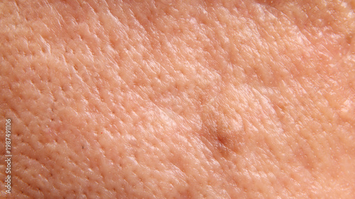 Macro closeup of human skin showing a raised mole or skin with visible pores uneven texture
