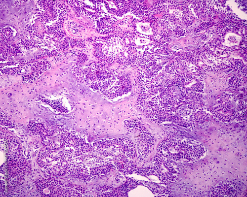 Parotid gland. Pleomorphic adenoma