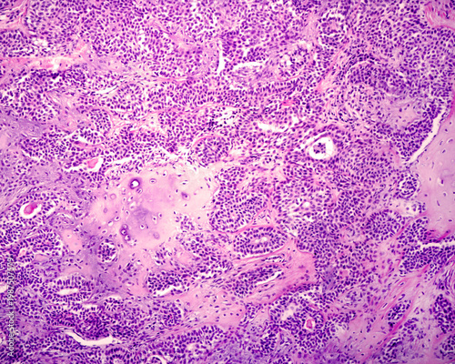 Parotid gland. Pleomorphic adenoma