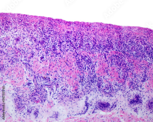 Human synovial membrane. Rheumatoid arthritis